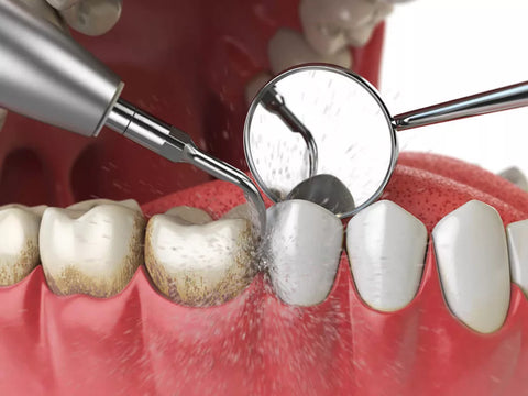 The Importance of Regular Dental Checkups and Cleanings